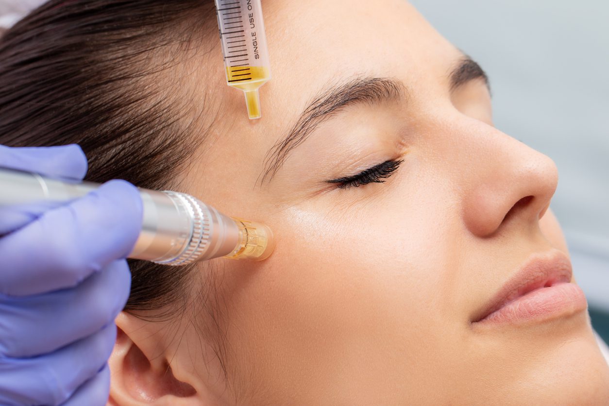 Macro close up of therapist injecting enzymes and with derma pen around woman's eyes.