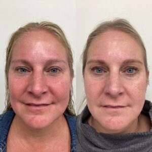 Aquafirme 1 month after 1 treatment