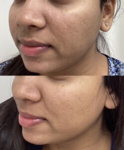 Aquafirme 1 month after 2 treatments